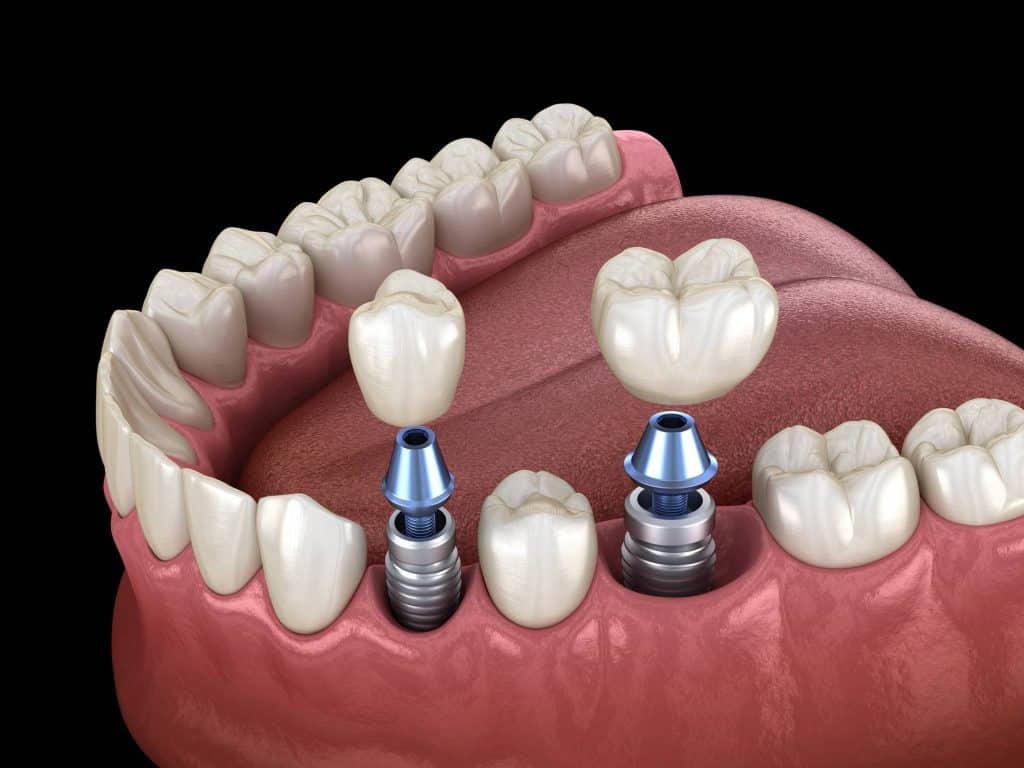 Implant dentaire impression 3D dent