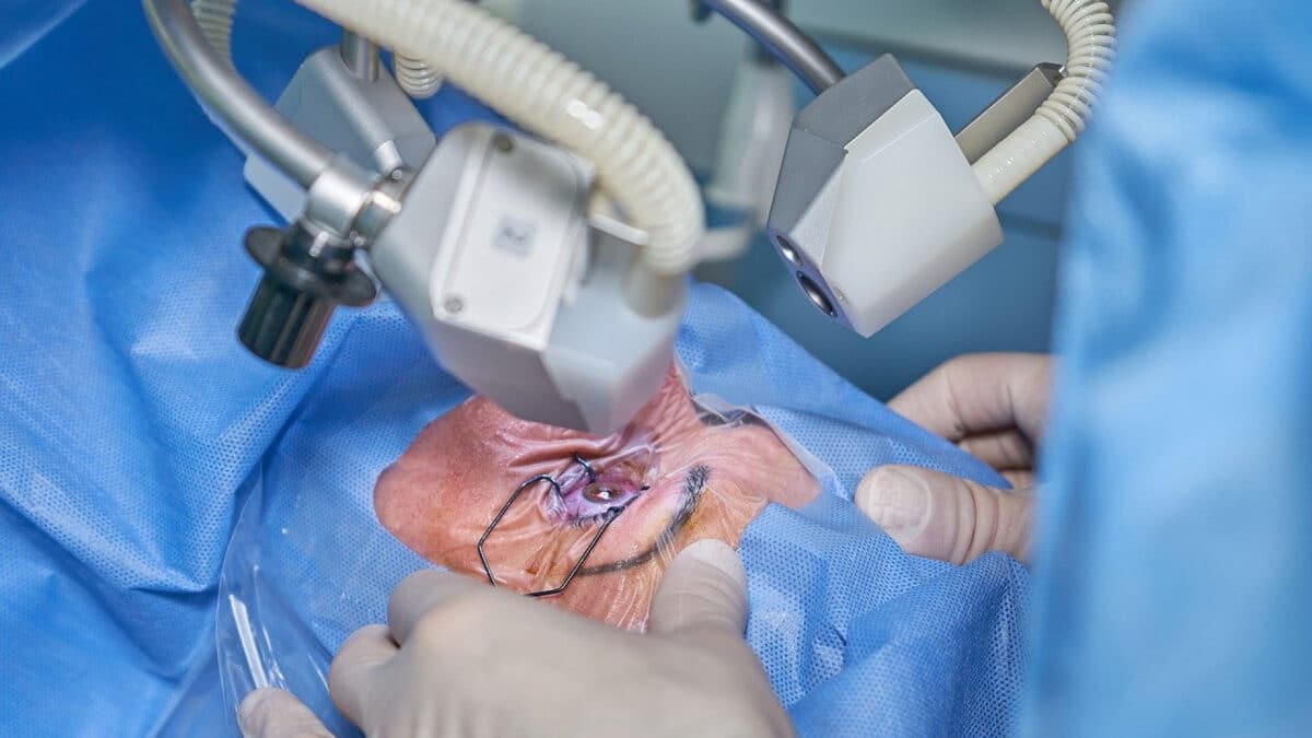 Traitement chirurgical de la cataracte : tout savoir sur cette intervention courante